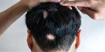 درمان ریزش مو سکه ای یا آلوپسی