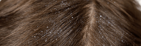 مؤثرترین و ساده‌ترین روش‌های درمان خانگی شپش موی سر 