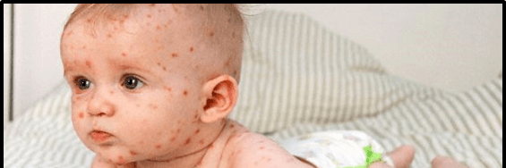 مؤثرترین روش‌های خانگی درمان حساسیت پوستی در کودکان 