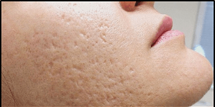 بهترین روش‌های درمان منافذ باز پوست صورت به همراه علل ایجاد آن‌ها 
